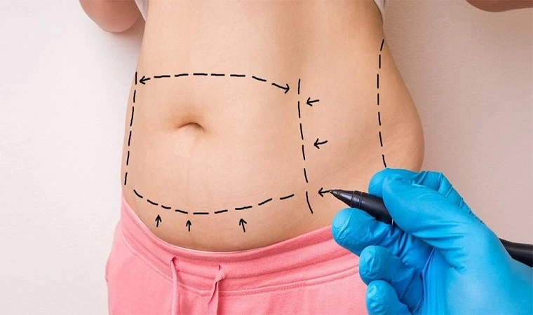 Liposuction Nedir? Yöntemleri Nelerdir?